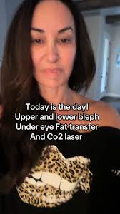 Surgery Day: Upper Blepharoplasty and Fat Transfer