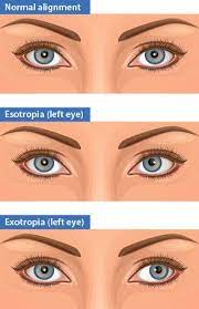 11 Exotropia Info Ideas Vision Therapy Eye Exercises Vision Eye