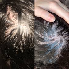 Thinning of crown can happen due to the androgens or other illnesses. Crown Thinning With Aga Femalehairloss