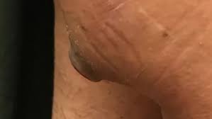 5 minute bartholin cyst video. Californian Doctor Pimple Popper Bursts Cyst In Gross Youtube Video Metro News