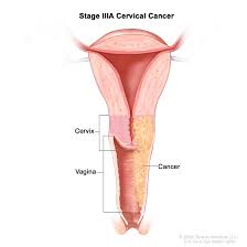 But where is the cervix, how deep is it, and what is a cervix? Cervical Cancer Treatment Pdq Patient Version National Cancer Institute