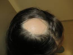 Onion juice was found to be effective in treating patchy alopecia areata (23). Alopecia Areata Patchy Head Hair Loss Download Scientific Diagram