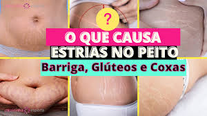 O Que Causa Estrias No Peito Barriga Gluteos E Coxas Fevereiro 2022