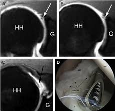 Image result for SLAP Lesion