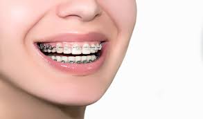 Teeth with braces need to use the best quality toothbrush like soft bristle or electric brush that can rotate to cover the most of the area and clean your teeth. How To Know If You Need To Tighten Your Braces Myorthodontist
