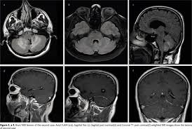 Dopaminergic agents in restless legs syndrome and dyskinesias while awake and periodic movements in sleep in restless legs syndrome: Two New Cases And Literature Review Of Clippers Syndrome With Long Term Follow Up Document Gale Onefile Health And Medicine
