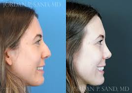 Rhinoplasty at 1 year