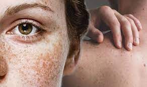 This is an early form of melanoma with an excellent prognosis. Skin Cancer Noticing These Three Changes In Your Freckles Could Be Signs Of Your Risk Express Co Uk