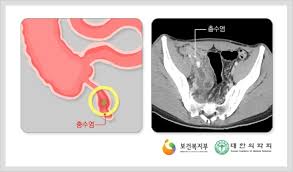 기사를 추천 하셨습니다이재용, 충수 터져 삼성서울병원서 응급 수술베스트 추천 뉴스. ì¶©ìˆ˜ì—¼ ì¦ìƒ ì¶©ìˆ˜ì—¼ ì¦ìƒì˜ ì›ì¸ ë° ì§„ë‹¨ê³¼ ìˆ˜ìˆ 