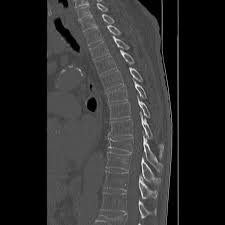 Image result for Vertebral Compression Fracture