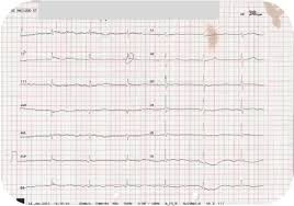 Prominent u waves fused to the end of the t wave, as seen in severe hypokalaemia; Electrocardiographic Manifestations In Three Psychiatric Patients With Hypothermia Case Report Sciencedirect
