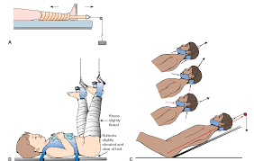 A.monitor the skin under the traction that hip and leg pain are normal after hip fracture.ans: A Bucks Traction B Bryant S Traction Left 15 Degrees Of The Bed For Best Results Pediatric Nursing Nursing School Studying Med Surg Nursing