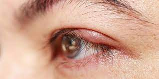 Anschließend können ebenfalls beruhigende augentropfen mit euphrasia oder zur nacht eine augensalbe mit dexpanthenol verwendet werden. Entzundung Des Augenlids