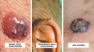 So, what exactly does skin cancer look like? What Does Skin Cancer Look Like A Visual Guide To Warning Signs Allure