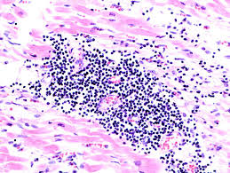 Die myokarditis ist eine umschriebene oder diffuse entzündliche erkrankung des herzmuskels. Pankarditis Definition And Synonyms Of Pankarditis In The German Dictionary