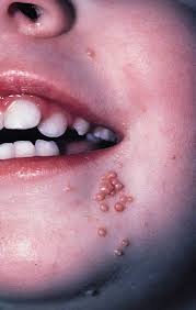 Secondly, when touched, they may not change colors. Rash In Infants And Young Children Pediatrics Msd Manual Professional Edition