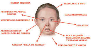 Sindrome De Down Una Nueva Vision Caracteristicas Mas Comunes