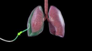 The free gas rises to the highest part of the ipsilateral thoracic cage, and. Treatment Of Pneumothorax Youtube