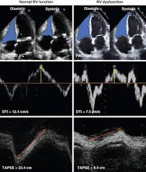 Nestled in the hillside, the roost gives a sense of oneness with nature. Prognostic Value Of Right Ventricular Dysfunction On Clinical Outcomes After Transcatheter Aortic Valve Replacement Jacc Cardiovascular Imaging X Mol