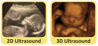 2d 3d Image Of A Miracle 4d Ultrasound Center