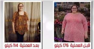 تكميم المعدة أهم 30 سؤال يجب معرفتهم قبل العملية