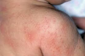 The type of hantavirus in korea and europe usually causes a rash and belly pain and can stop your kidneys from working. Hantavirus Pictures Of Hantavirus Rash