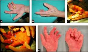 Image result for Hand Extensor Tendon Injury