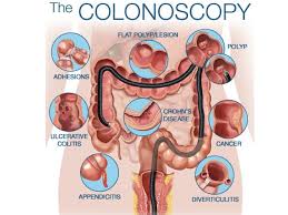 Often that's because they're afraid of what they have to go. Colonoscopy Procedure At Mission Gastro Hospital