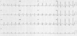 Ecg Sinus Tachycardia Rbbb 1200 Sinus Tachycardia Svt Medical