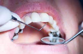 When most people think about cavities, they imagine tiny holes in the surface of teeth. Should You Worry About Mercury In Your Silver Dental Fillings Health Essentials From Cleveland Clinic