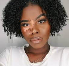Vitiligo may occasionally start as multiple halo naevi. Can Hair Dye Cause Vitiligo Or Make It Worse Living Dappled