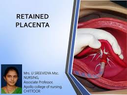 Image result for Retained Placenta