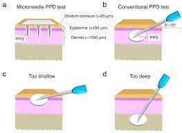 Microneedle Patch Could Replace Standard Tuberculosis Skin Test Uw News
