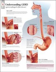 When you have gerd (chronic acid reflux) your stomach acid persistently flows back up into your mouth through your esophagus. 34 Gastroesophageal Reflux Disease Gerd Ideas Gastroesophageal Reflux Disease Reflux Disease Gerd