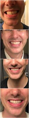 The acid % is super stronger in office and. I Wore Crest Whitestrips For 14 Days And Here S What Happened