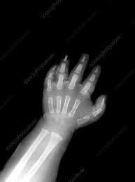 Image result for Hand XRay