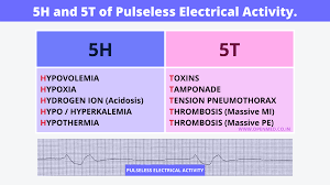 Image result for Pulseless Electrical Activity