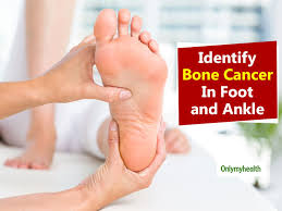They may arise from the bone tissue, and we call them primary bone tumors. Major Signs That Indicate Bone Cancer In Foot And Ankle