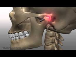 Tmj Video Temporomandibular Joint Youtube Temporomandibular Joint Joints Anatomy Temporomandibular Joint Disorders