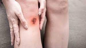 5 Ways To Get Rid Of Scabs Fast