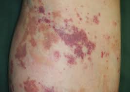 A few skin lesions resemble malignancies. Unilateral Lower Leg Purpura