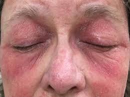 The presenting signs of eyelid skin cancers are highly variable. Eyelid Dermatitis Eczema Uptodate