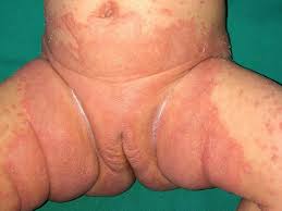 Image result for Skin Infection