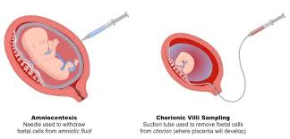 Image result for Chorionic Villus Sampling