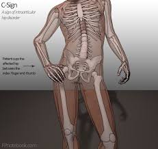 Image result for FABER Test