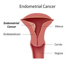Whether this or another condition is the cause of the bleeding, it is important to take vaginal bleeding after menopause seriously. Endometrial Cancer Treatment Surgery Bangalore Uterine Cancer Treatment India