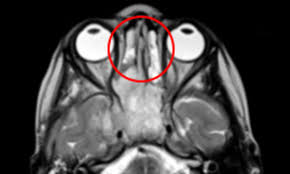 Instead, they're typically the result of chronic inflammation from: Toddler Is Diagnosed With Nasal Cancer After Doctors Said Her Runny Nose Was A Sinus Infection Daily Mail Online