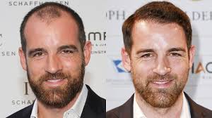 Christoph metzelder is the brother of malte metzelder. Christoph Metzelder Hat Sich Haare Transplantieren Lassen