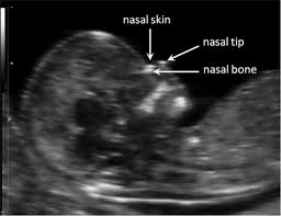 First Trimester Screening For Trisomy 21 By Maternal Age Nuchal Translucency And Fetal Nasal Bone In Unselected Pregnancies Intechopen