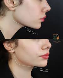 English/كوردی/عربي . . . . . . ✅️Jawline definition by filler 💉 ✅️Russian  lip filler 💉 ✅️ريككاري شه ويلگه و چه ناكه به فيله ر ✅️تحديد الفك وابراز  الذقن بالفلر 💉 ✅️دكتور